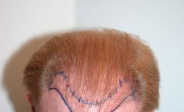 Repair case performed by Dr. Feriduni – 7425 FU in 3 procedures